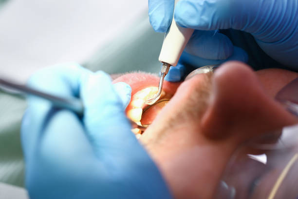 Best Dentist for Tooth Abscess  in Farmersville, OH