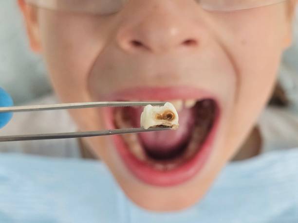Best Cracked Tooth Emergency Dentist  in Farmersville, OH